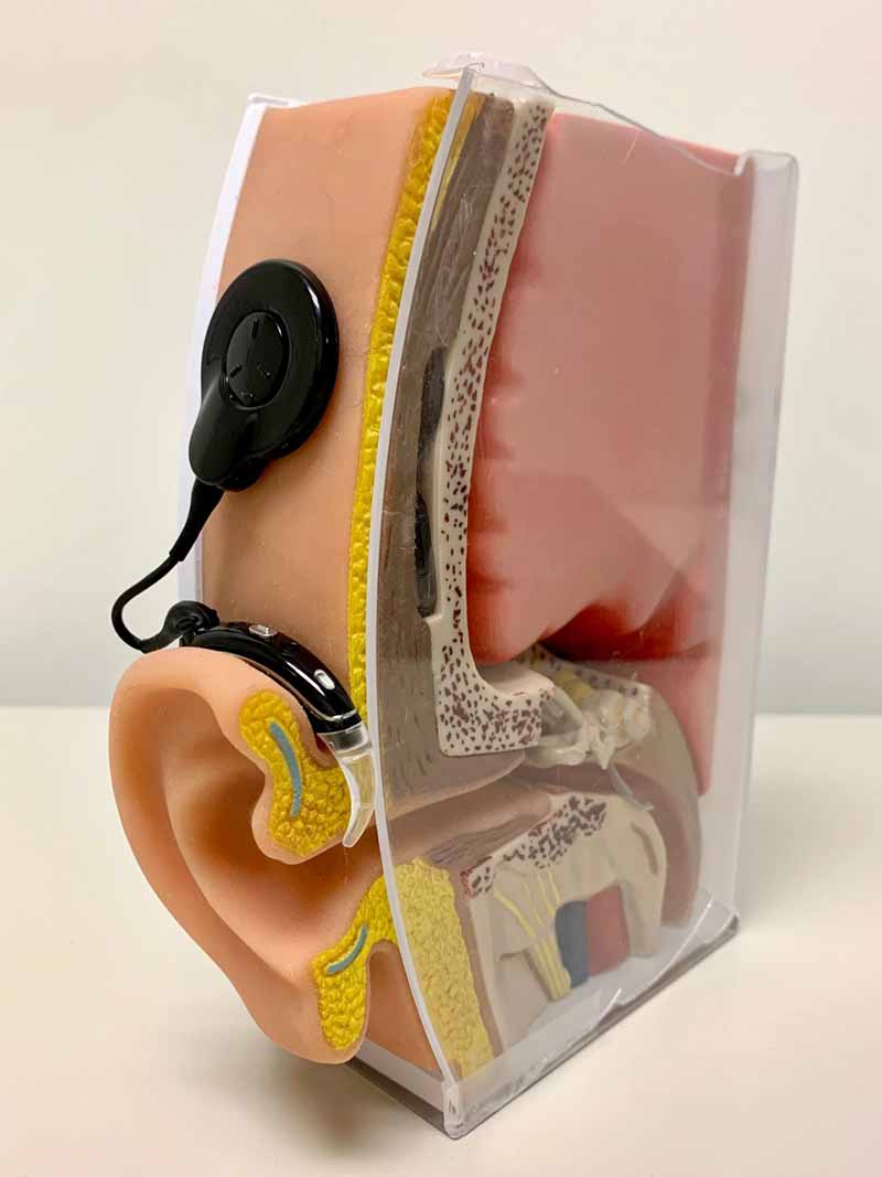 A cross section biomedical model of an ear with a cochlear implant.