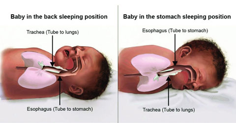 In the picture on the left, an infant is lying on his back. The illustration includes a drawing of his trachea and esophagus. In the picture on the right, an infant is lying on his stomach. The illustration includes a drawing of his esophagus and trachea.
