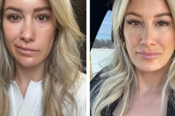Before-and-after images show a woman with facial synkinesis. In the first image, her mouth pulls toward the upper-left. In the second image, her mouth is symmetrical.