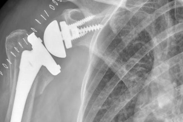 X-ray of a shoulder with a reverse shoulder replacement joint installed